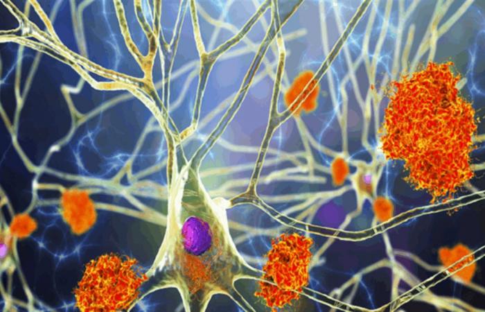 ما سبب تدهور الذاكرة السريع لدى مرضى ألزهايمر؟